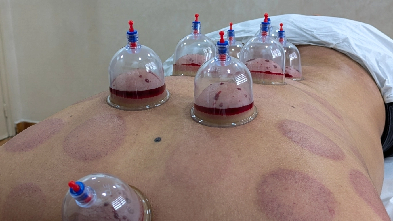 A traditional Moroccan Hijama (cupping therapy) session showing glass cups on a person's back to improve blood circulation and recover from travel fatigue.
